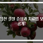 갑상선 결절 증상과 치료법 모두 공개!