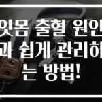 잇몸 출혈 원인과 쉽게 관리하는 방법!